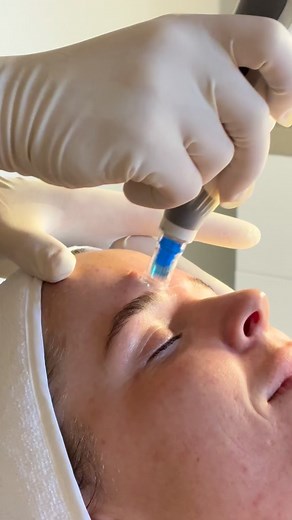 Here’s why skin needling is the best option to transform your skin. You’ve done the facials, tried the products, and hoped for change, but your skin still doesn’t feel like you. Because surface treatments can’t fix what’s happening deeper within. Skin needling rebuilds your collagen from the inside out, repairing scars, refining pores, softening lines, and restoring your natural glow. But now… we’re taking it even further. Introducing Exosomes — the most advanced infusion in skin regeneration. C