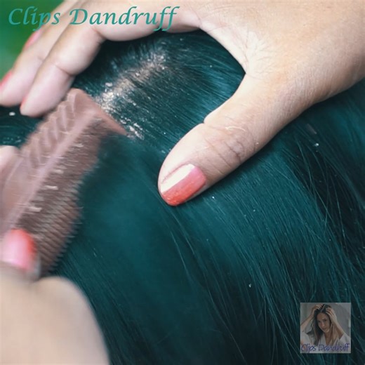 Clean Dandruff for Healthy Scalp by Scratching! 128 | Clips Dandruff