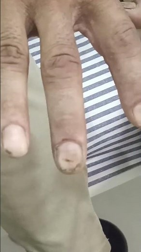 "Alcoholic Hand Tremors and Pallor: A Visual Guide to Understanding Symptoms"