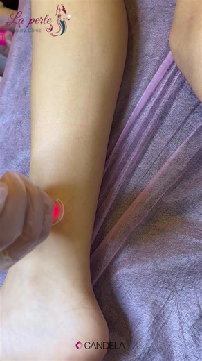 5.8K views · 1K reactions | It's a wonderful time to start your laser...