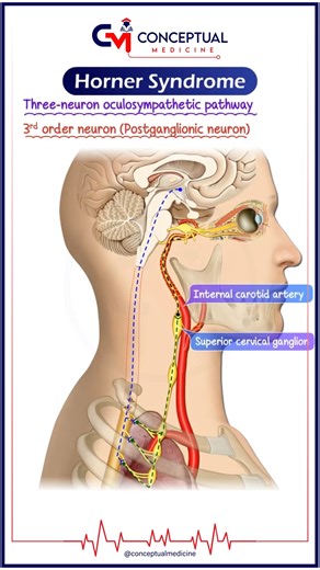 Conceptual Medicine on Instagram: "🔍 Horner Syndrome (HS) Animated Quick Review Horner syndrome is a neurological disorder caused by interruption of the ipsilateral sympathetic pathway supplying the eye, face, and neck. 🚨 Classic Triad (Remember M-P-A) • Miosis 👁️ – constricted pupil • Partial ptosis 😴 – drooping of upper eyelid (Müller muscle) • Anhidrosis 💦❌ – loss of facial sweating 🧠 Pathophysiology Damage to the sympathetic chain → loss of sym