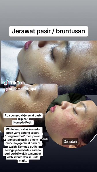 Jerawat Pasir / Bruntusan: Apa Penyebab dan Solusi Terbaik?