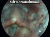 Intubation Granuloma involving the right arytenoid area • Video • MEDtube.net