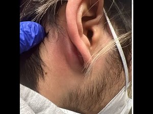 Mastoiditis vs. Posterior Auricular Abscess and/or Epidermoid Cyst?