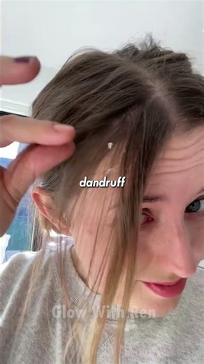 Dandruff Types You Didn’t Know About 😱🧴 Hair Health Tips