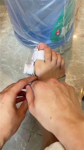 Easy Ingrown Toenail Treatment at Home 🦶 Pain Relief & Nail Care Tips 💅🔥