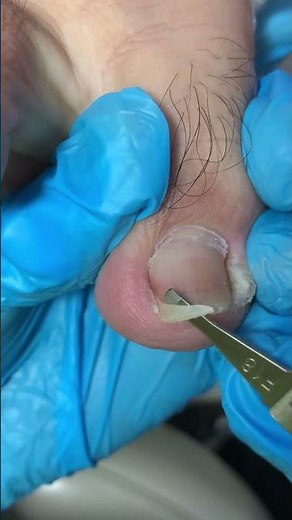 Cut Off The Long, Thin Inlay Nails! #nails #pedicure