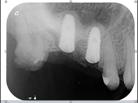 Indirect Sinus Lift with Novabone Putty.