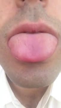 Tongue Fasciculation (or something else)