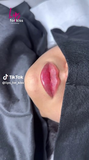 Arabian Lips Augmentation Techniques in Major Cities