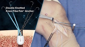 Double Knotted Knee FiberTak® Anchor Product Demonstration