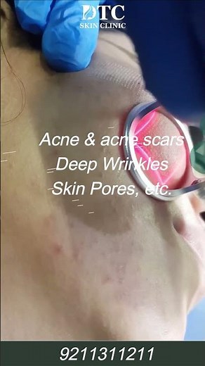 Fractional Laser Treatment | DTC Skin Clinic