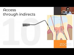 ACCESS OPENING in ROOT CANAL TREATMENT - Clinical Tips and Tricks