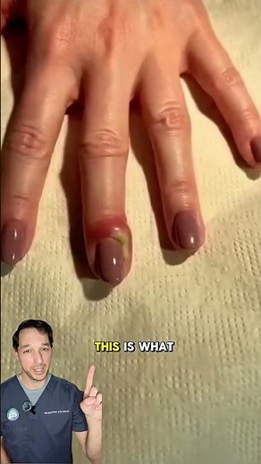 The most common finger infection I see #finger #infection #medicalstudent #fingertip #manicure