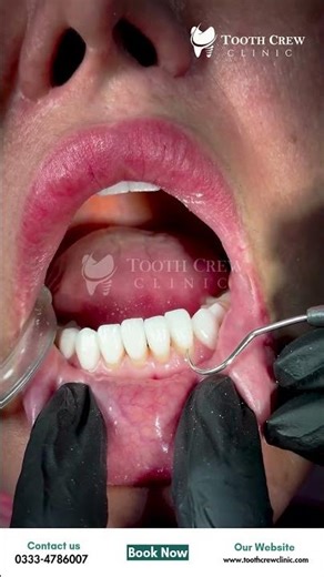 Veneers Unbelievable Smile Makeover Transformation | Tooth Crew Clinic Islamabad