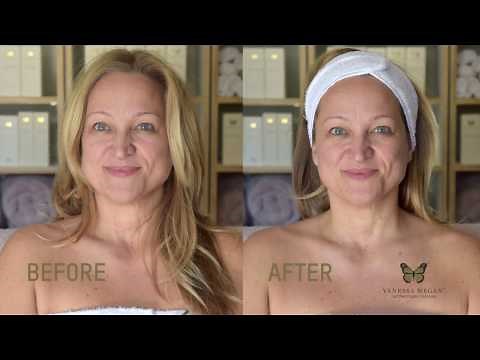 CRYO FACELIFT™ - ICE CUBE TREATMENT