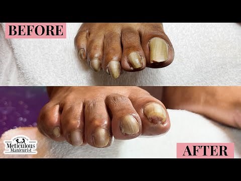 Thick Yellow Toenails - Client Pedicure Transformation