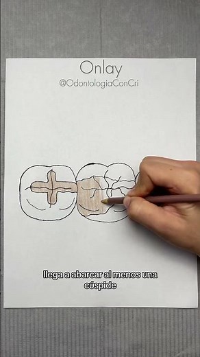 Indirect restorations, inlays, onlays, and overlays #dentistry