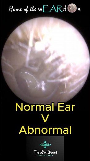 Normal V Abnormal Ear #facinating #ear #earcare