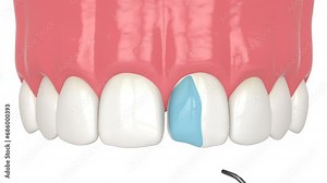 Crooked tooth treatment using bonding procedure with composite resin