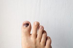 9 Things That Can Cause a Black Toenail and Treatments That Help