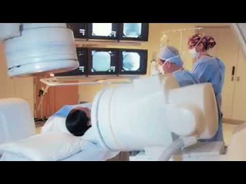 Thrombectomy, a surgical procedure that is transforming stroke care.