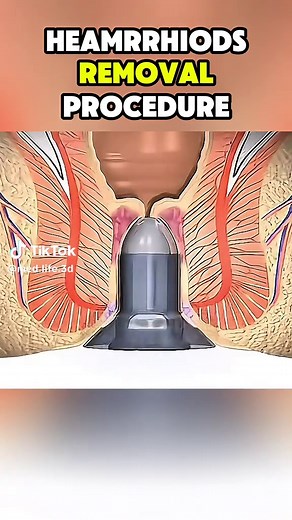 Ever wondered how hemorrhoids are removed? ✨ This common procedure can relieve pain, bleeding, and swelling caused by enlarged veins, helping patients restore comfort and quality of life. #HemorrhoidsRemoval #LaserSurgery #MedicalEducation #HealthAwareness #DoctorTok Disclaimer: ⚠️ This video is for educational purposes only. It is not medical advice and should not replace consultation with a licensed healthcare professional. Always seek proper evaluation, diagnosis, and treatment for hemorrhoid