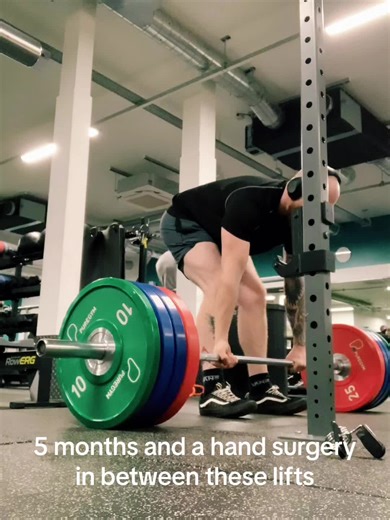 These are 5 months, and a hand surgery apart. I’ve really struggled to see progress with training this year and I probably will continue to. But training is not only for getting stronger, it’s to maintain mental and physical health. Training ill, hungover, injured, tired, angry, sad and whatever else keeps me hungry for self improvement.. #gymprogress #onlinefitness #squat #deadlift #pushup #fitnessprogress #fitnessinspo #workoutmotivation #workout #fitnessjourney #fitnesspost #calisthenics #gym