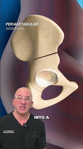 The Pelvis Cuts That Saves Your Hip Joint #orthopedics #hipdysplasia #shorts