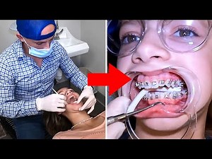 Getting BRACES ON!! what to know before getting Braces [full process]