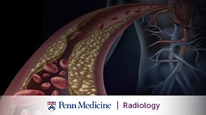 Complex Retrieval of Embedded Inferior Vena Cava Filters in Interventional Radiology