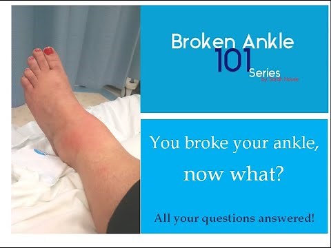 You broke your ankle, now what? | Broken Ankle 101 Series | Breaking my ankle | Ankle Recovery