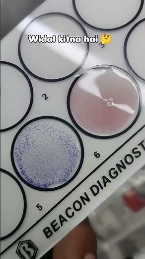 How to perform a WIDAL Test || widal test procedure || widal test kaya hota hai #widaltest #trend