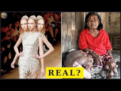 18 Humans With The Rarest Conditions On Earth | Then and Now 2026