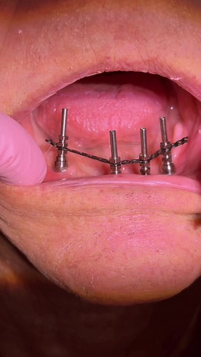 Remaking a temporary set #denturegang #dentallab #denture_conversions #smile #transformation #fyp #dental #satisfying #foryoupage❤️❤️