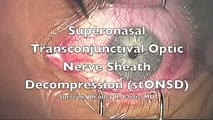 Superonasal Transconjunctival Optic Nerve Sheath Decompression (stONSD) | NOVEL