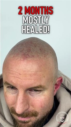 This Is What Real Scalp Micropigmentation Looks Like #scalpmicropigmentation #smp #love