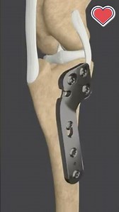 Ariel’s second surgery 2024 - Tibial Plateau Leveling Osteotomy TPLO — bone cut, plat...
