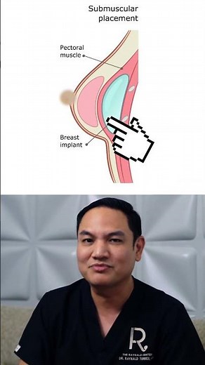 Part 2: FAKE VS. NATURAL LOOKING IMPLANTS