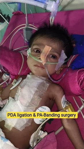 PDA Ligation & PA Banding Surgery 🚨 Newborn Cardiac Case | NICU #suryanursingvlog #nicu #shorts #yt