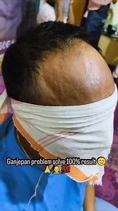 Ganjepan problem solve 100% result 😊🙏🧑‍🦲💯 | Salman Hair Treatment