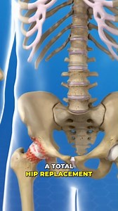 1.8M views · 5.7K reactions | Total hip replacement explained (3D Animation). #doctor #documentaryphotography #DoctorWho # reel # shorts #DoctorWh# | SMART Doctor | Facebook