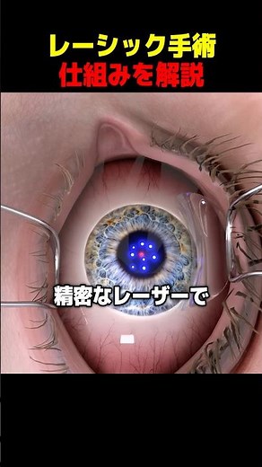 レーシック手術仕組みを解説
