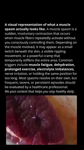 A visual representation of what a muscle spasm actually looks like.
