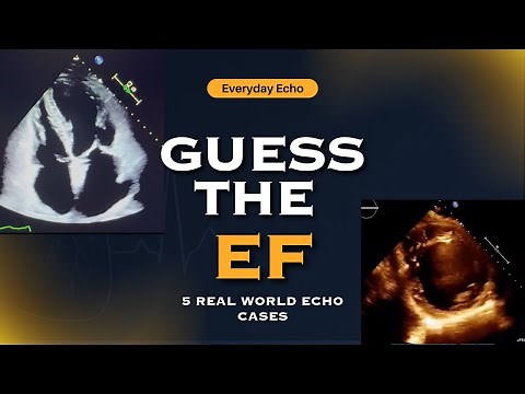 Guess the EF: 5 Real Echo Cases to Test Your Echocardiography Skills (Visual Ejection Fraction)