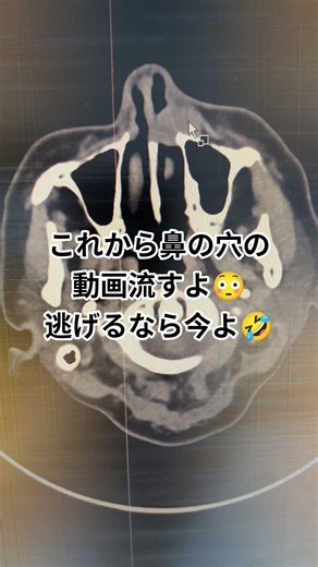 # #乳がんステージ4 #手術不可#癌サバイバー 2026.7.23 左鼻の嚢胞検査