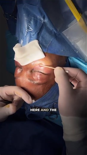 Lower blepharoplasty fat repositioning + fat grafting + Microneedling