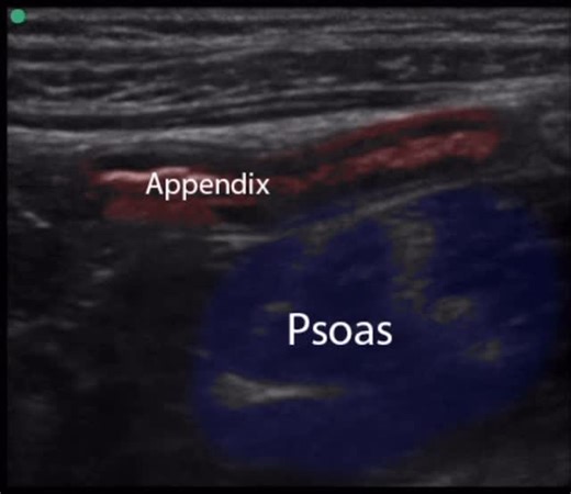 Uramah Stephen U. on Instagram: "Quick Summary on Appendicitis‼️ A normal appendix has a maximum diameter of 6mm. It’s surrounded my fat, homogeneous non-inflamed tissue. On ultrasound, a normal appendix may be difficult to visualize and often contains intraluminal gas. On ultrasound, supportive sign for Appendicitis is hypervascularity of the appendix wall on colour doppler sonography. If ultrasound diagnosis appendicitis, a CT is best advised for further work up for confirmation. Clinical symp