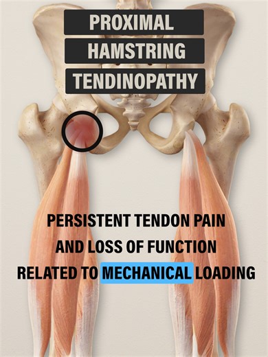 Proximal Hamstring Tendinopathy Rehab#fyp #physicaltherapy #physiotherapy #e3rehab #hamstrings