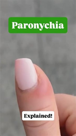 Paronychia explained! Learn how to deal with an infected nail